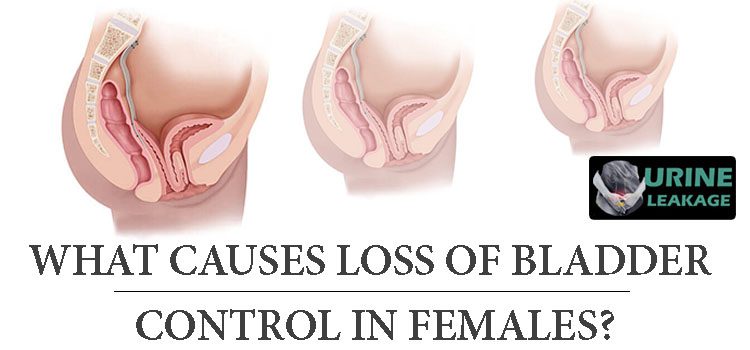 What causes loss of bladder control in females? 