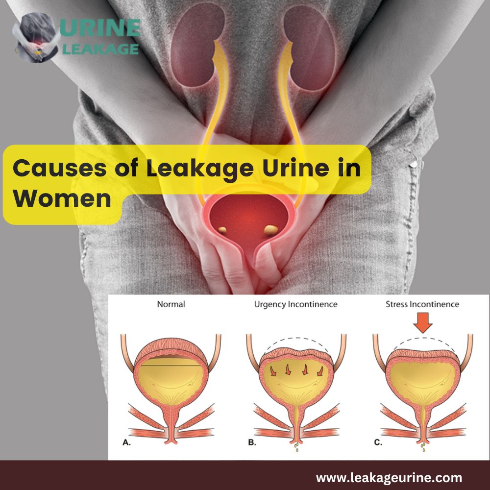 Causes of Leakage Urine in Women